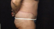 Abdominoplasty