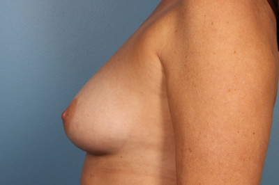 Breast Augmentation