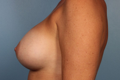 Breast Augmentation