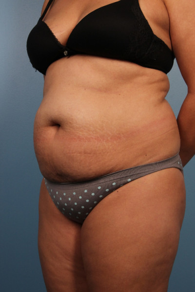 Abdominoplasty