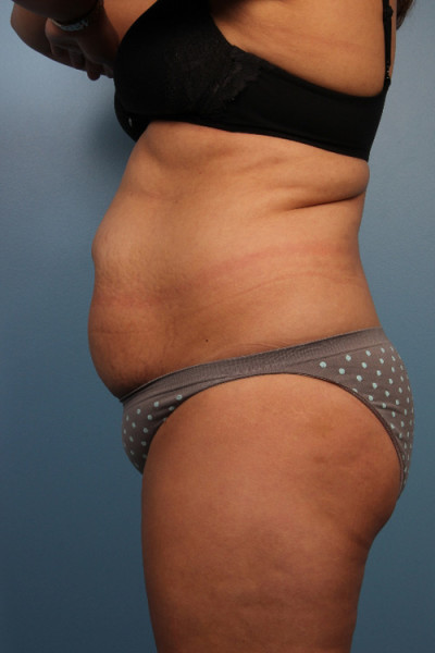 Abdominoplasty