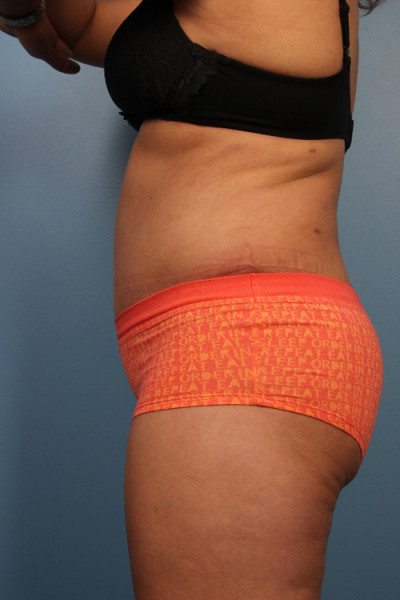 Abdominoplasty
