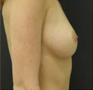 Breast Augmentation