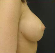 Breast Augmentation