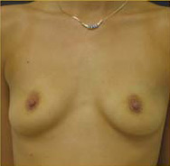 Breast Augmentation