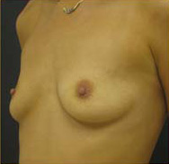 Breast Augmentation