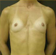 Breast Augmentation