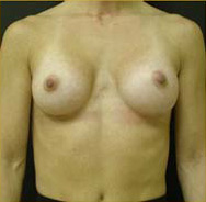 Breast Augmentation