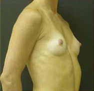 Breast Augmentation