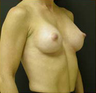 Breast Augmentation