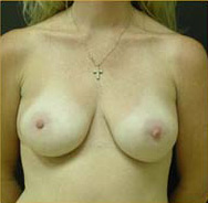 Breast Augmentation