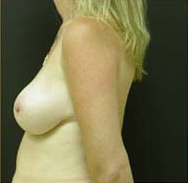 Breast Augmentation