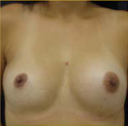 Breast Augmentation