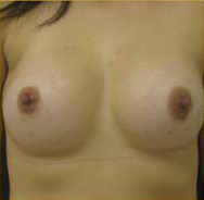 Breast Augmentation