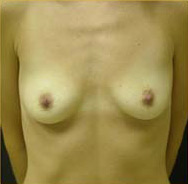 Breast Augmentation