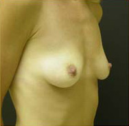 Breast Augmentation