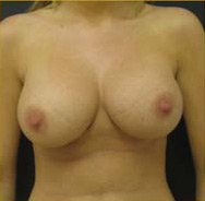 Breast Augmentation