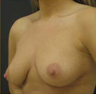 Breast Augmentation