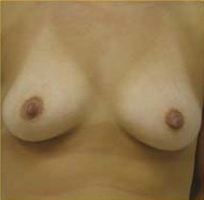 Breast Augmentation