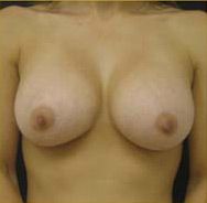 Breast Augmentation