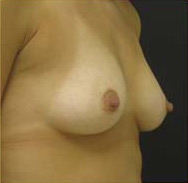 Breast Augmentation