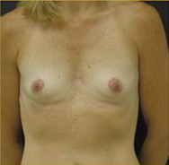 Breast Augmentation