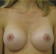 Breast Augmentation