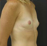 Breast Augmentation