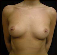 Breast Augmentation