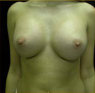 Breast Augmentation