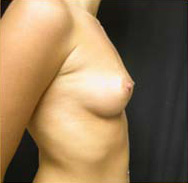 Breast Augmentation