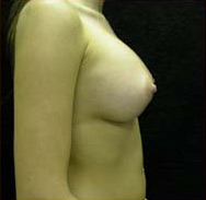 Breast Augmentation