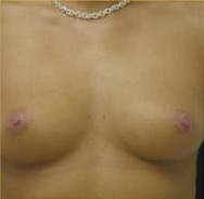 Breast Augmentation