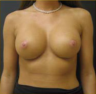 Breast Augmentation