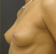 Breast Augmentation