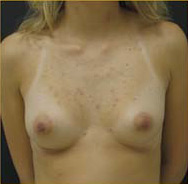 Breast Augmentation