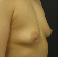 Breast Augmentation