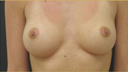 Breast Augmentation