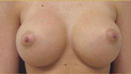 Breast Augmentation