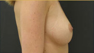 Breast Augmentation