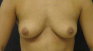 Breast Augmentation