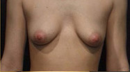 Breast Augmentation