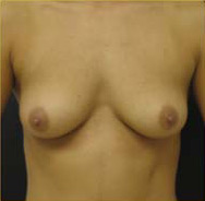 Breast Augmentation