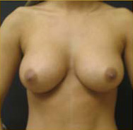 Breast Augmentation