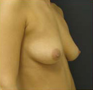 Breast Augmentation