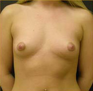 Breast Augmentation