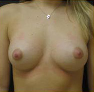 Breast Augmentation