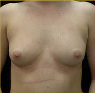 Breast Augmentation