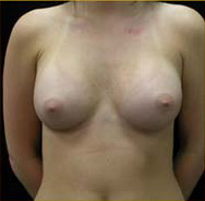 Breast Augmentation