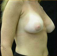 Breast Augmentation